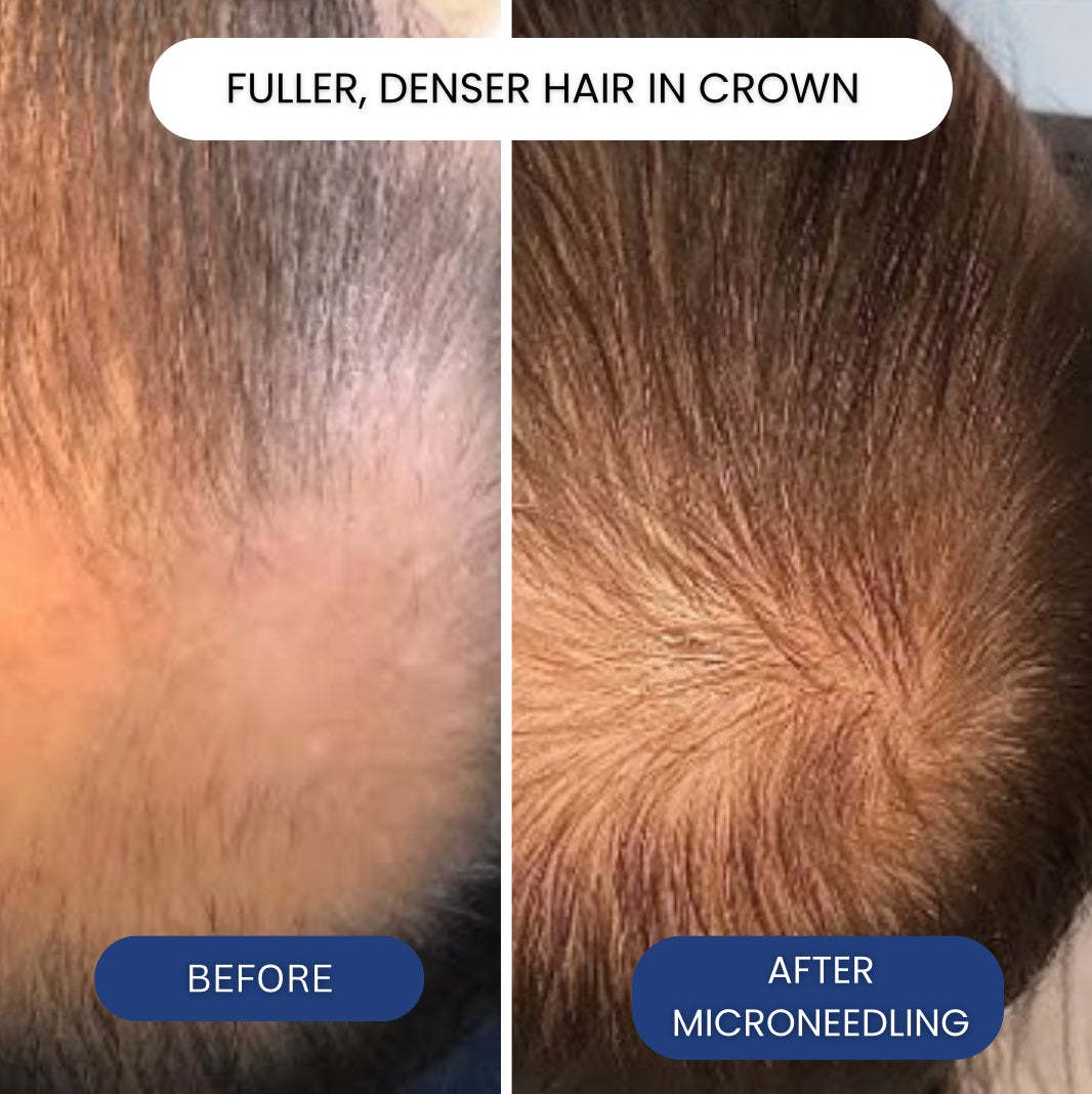 Hair Regrowth Microneedling GH - Peptide Complex Serum ulasan dan harga