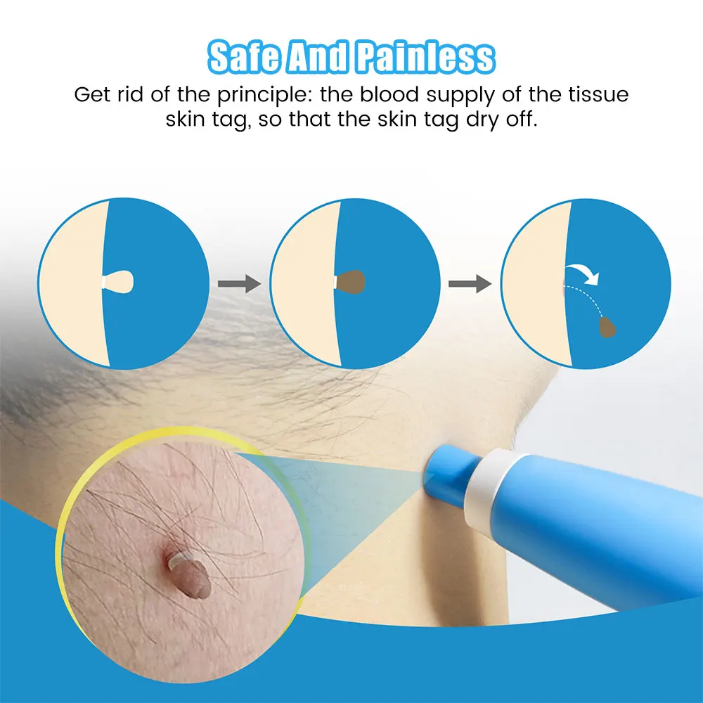 Auto Skin Tag Removal Tool Kit - Luxury Skincare Acne ulasan dan harga